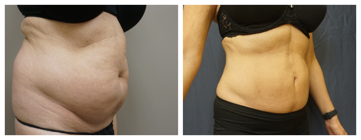 Example of Abdomen Flank Liposuction, Akkary Surgery Center