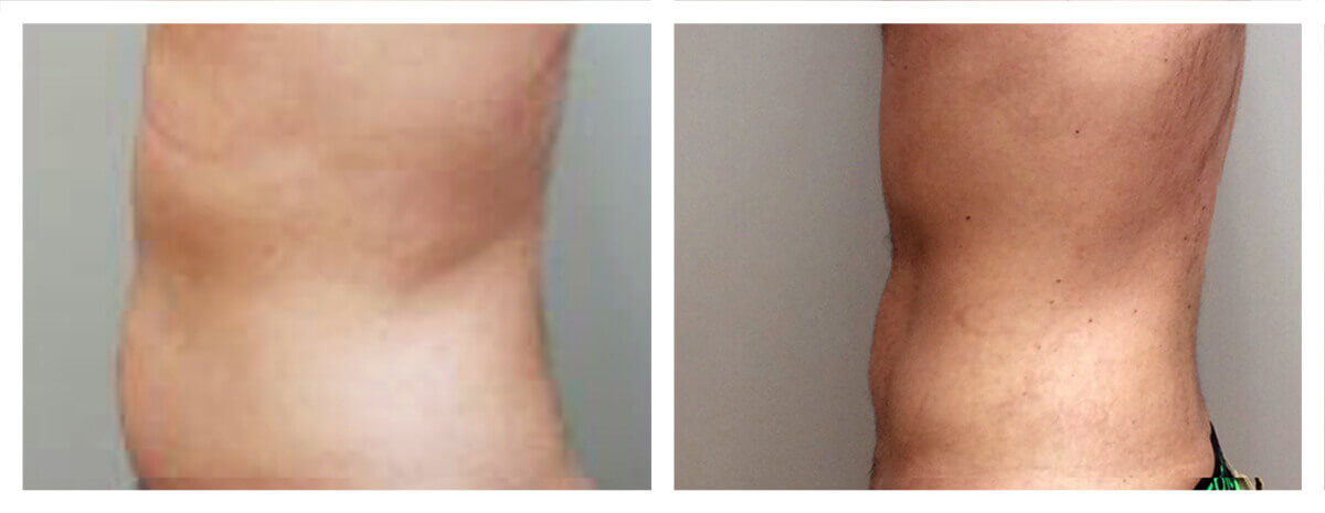Example of Abdomen Liposuction for male patient, Dr. Akkary