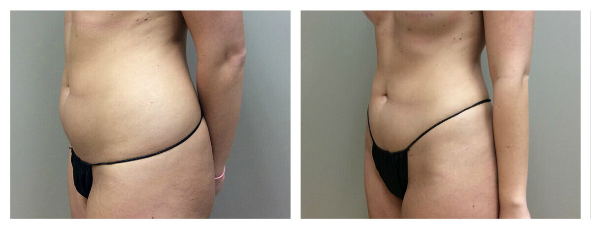 Example of Abdomen Liposuction for female patient, Dr. Akkary