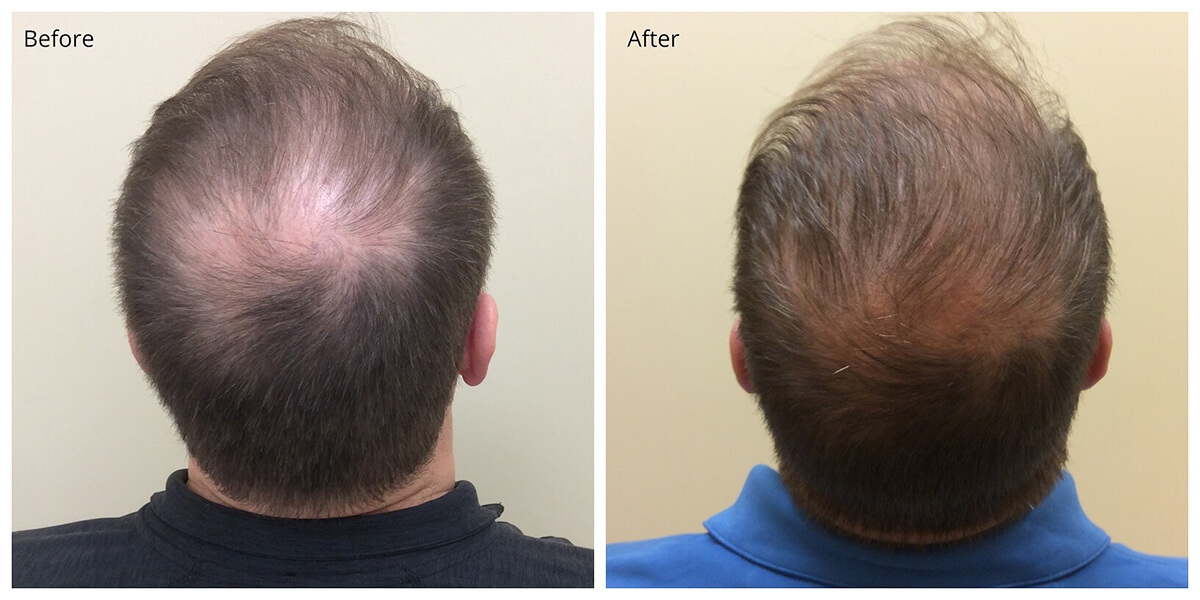 PRP Before and After, Hair Restoration, Dr. Akkary, Morgantown, WV