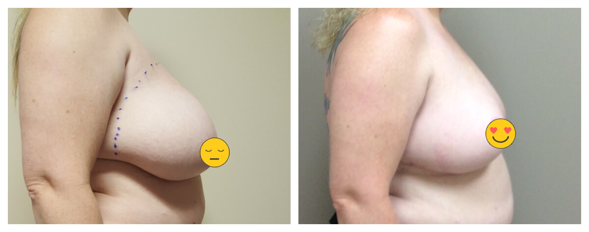 Example of Breast Reduction. Akkary Surgery Center. Morgantown, WV