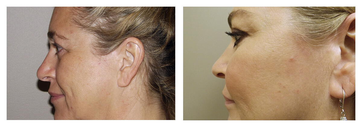 Example of Cheek Implants, Dr. Akkary, Morgantown, WV