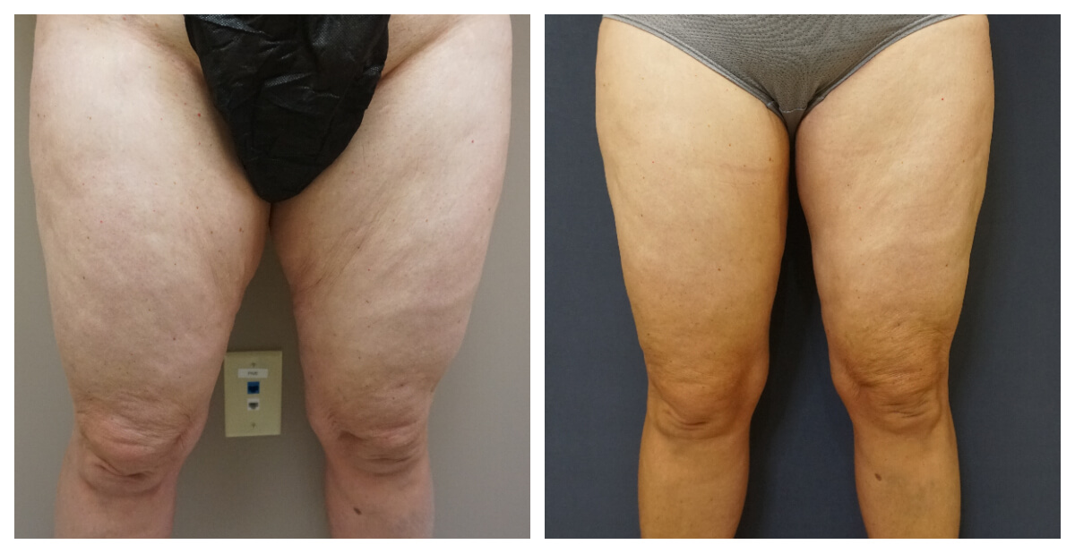 Example of Thigh Lift. Akkary Surgery Center in Morgantown, WV