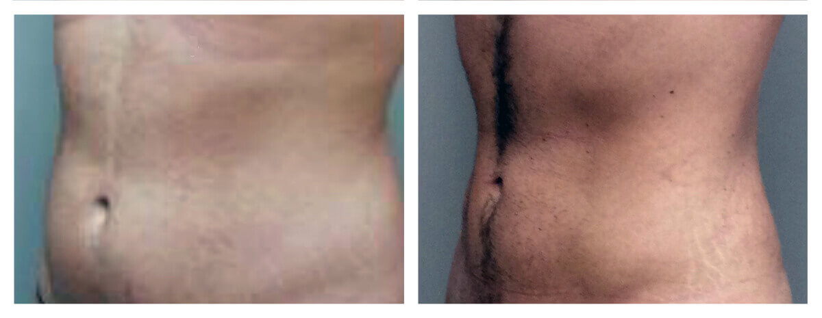 Example of Abdomen Liposuction for male patient, Dr. Akkary