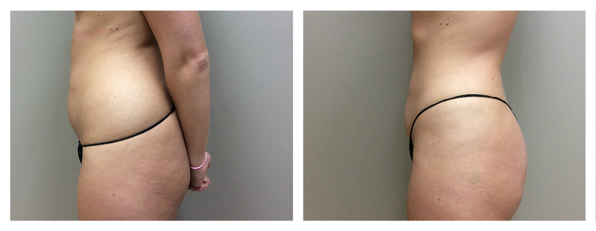 Example of Abdomen Liposuction for Female patient, Dr. Akkary