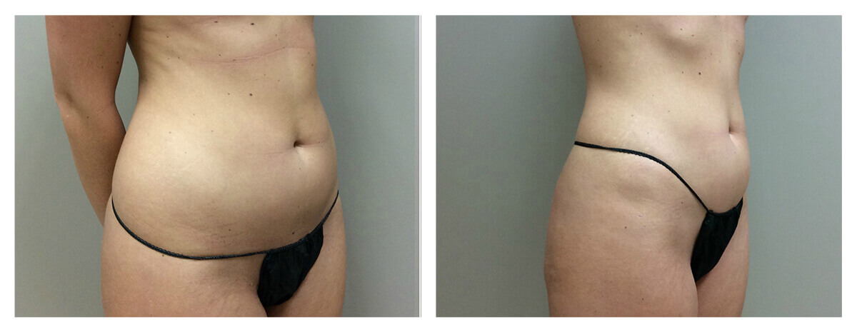 Example of Abdomen Liposuction for Female patient, Dr. Akkary