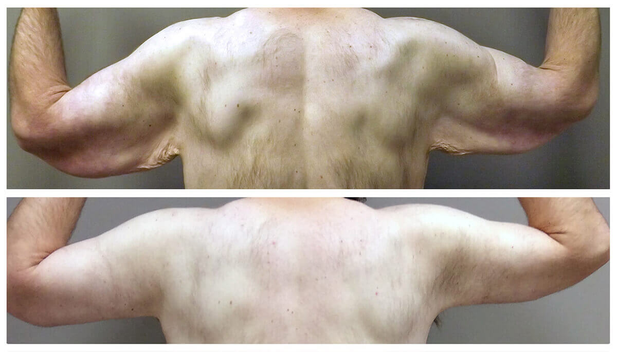 Example of Arm Lift for male patient, Dr. Akkary, Akkary Surgery Center, Morgantown, WV