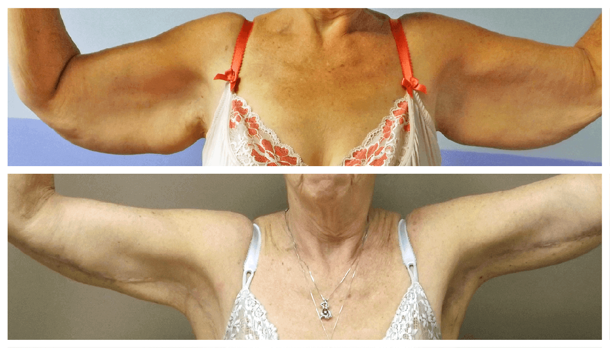 Example of Arm Lift for female patient, Dr. Akkary, Akkary Surgery Center, Morgantown, WV