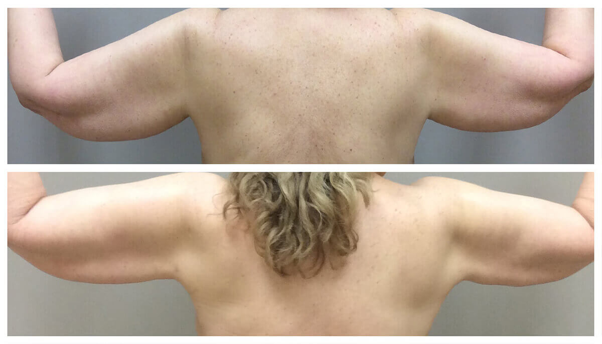 Example of Arm Liposuction for female patient, Dr. Akkary, Akkary Surgery Center, Morgantown, WV