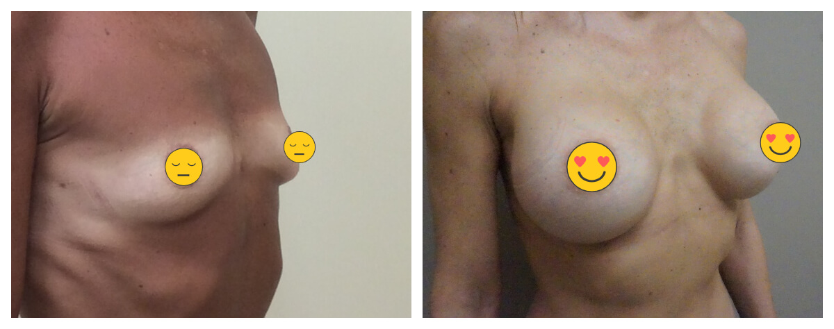 Example of Breast Augmentation. Akkary Surgery Center. Morgantown, WV