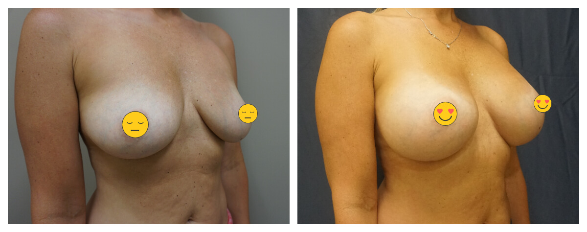 Example of Breast Augmentation. Akkary Surgery Center. Morgantown, WV