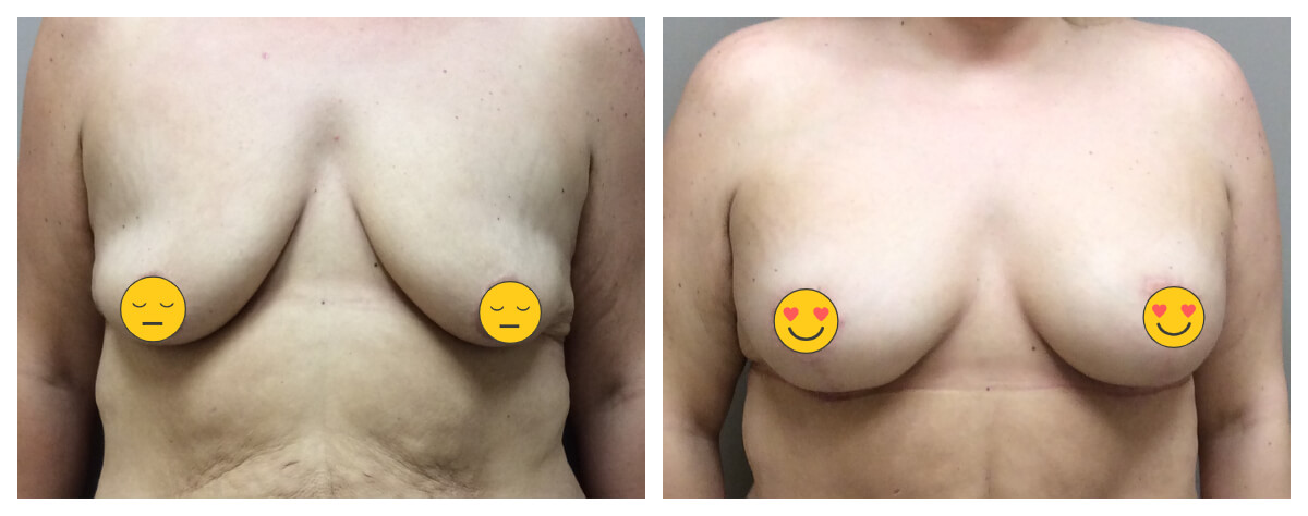 Example of Breast Lift. Akkary Surgery Center. Morgantown, WV