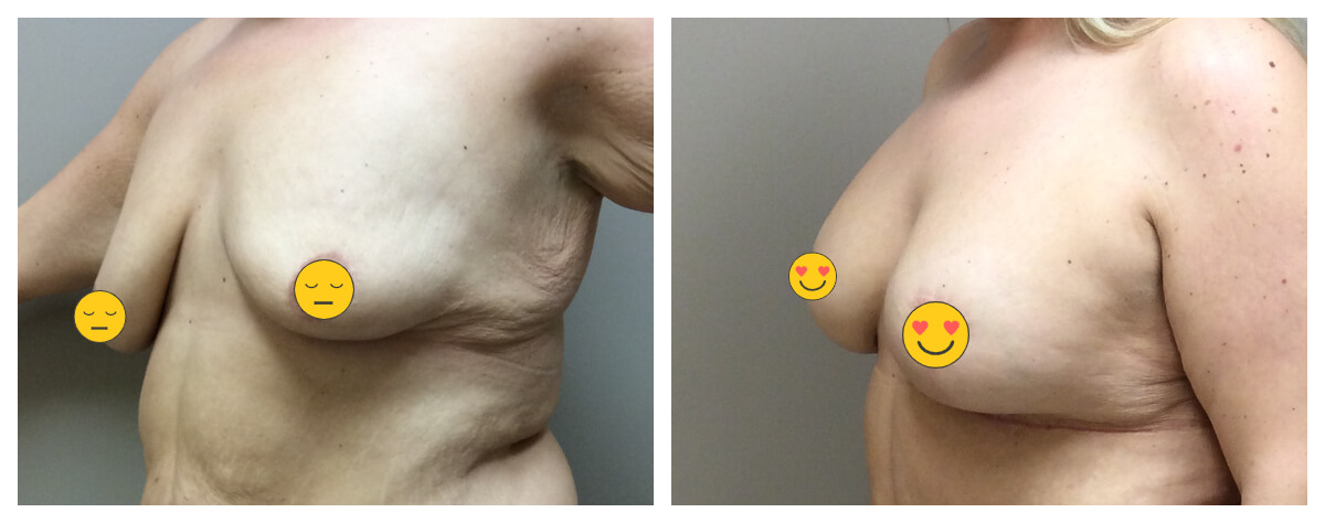 Example of Breast Lift. Akkary Surgery Center. Morgantown, WV