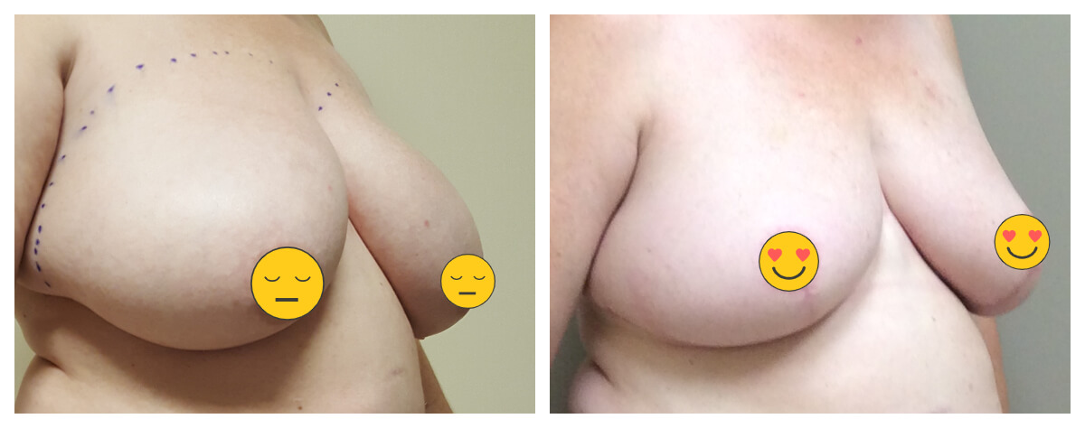 Example of Breast Reduction. Akkary Surgery Center. Morgantown, WV