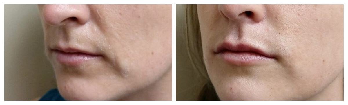 Dermal Filler Lips. Skinsational Medspa Morgantown, WV