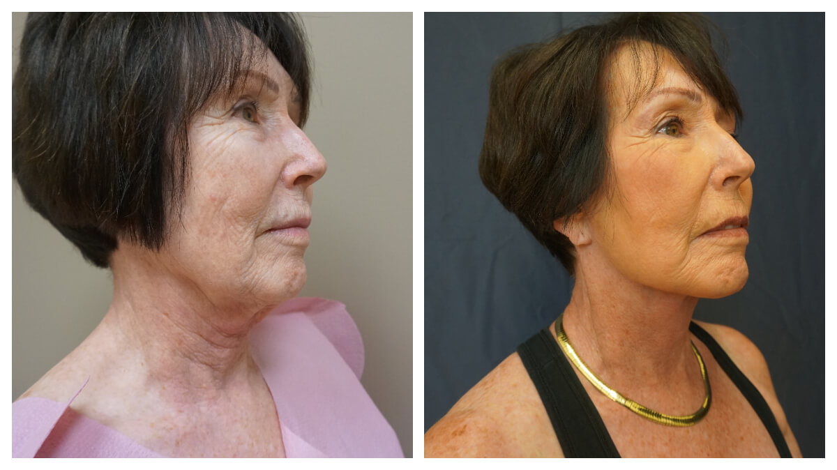 Example of Face Lift. Akkary Surgery Center in Morgantown, WV