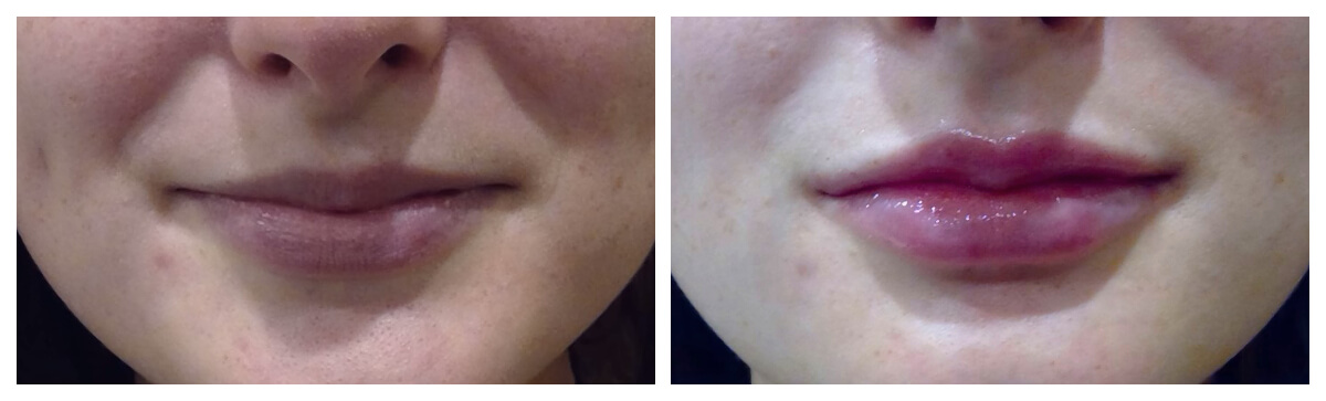 Example of Lip Fillers. Skinsational Medspa. Morgantown, WV