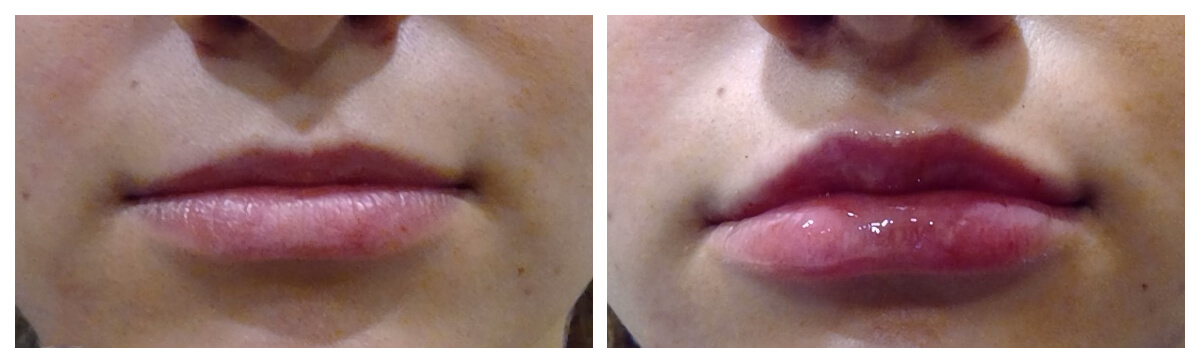 Example of Lip Fillers, Skinsational Medspa, Morgantown, WV