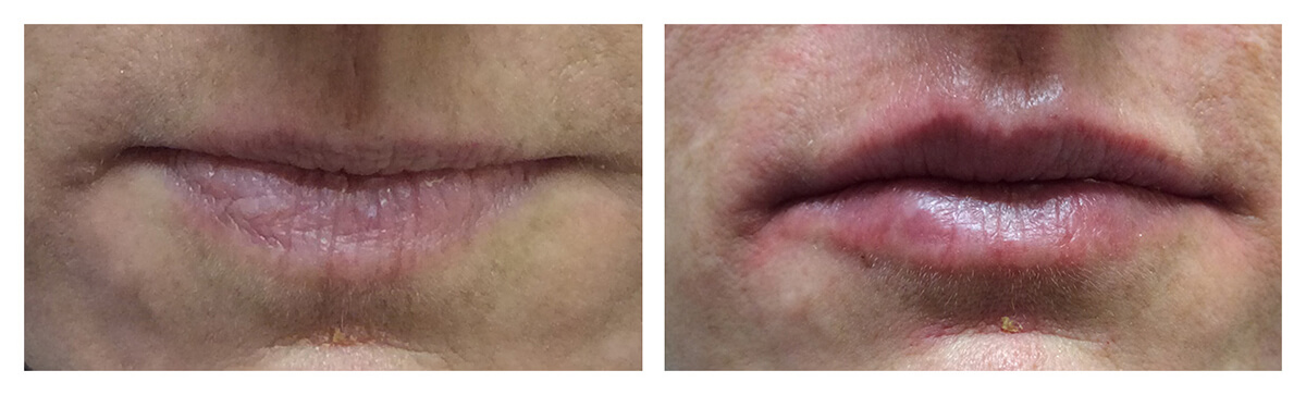 Example of Lip Augmentation, Lip Fillers, Dr. Akkary, Morgantown, WV