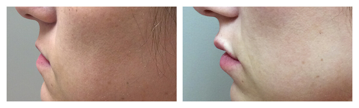 Example of Lip Augmentation, Lip Fillers, Dr. Akkary, Morgantown, WV