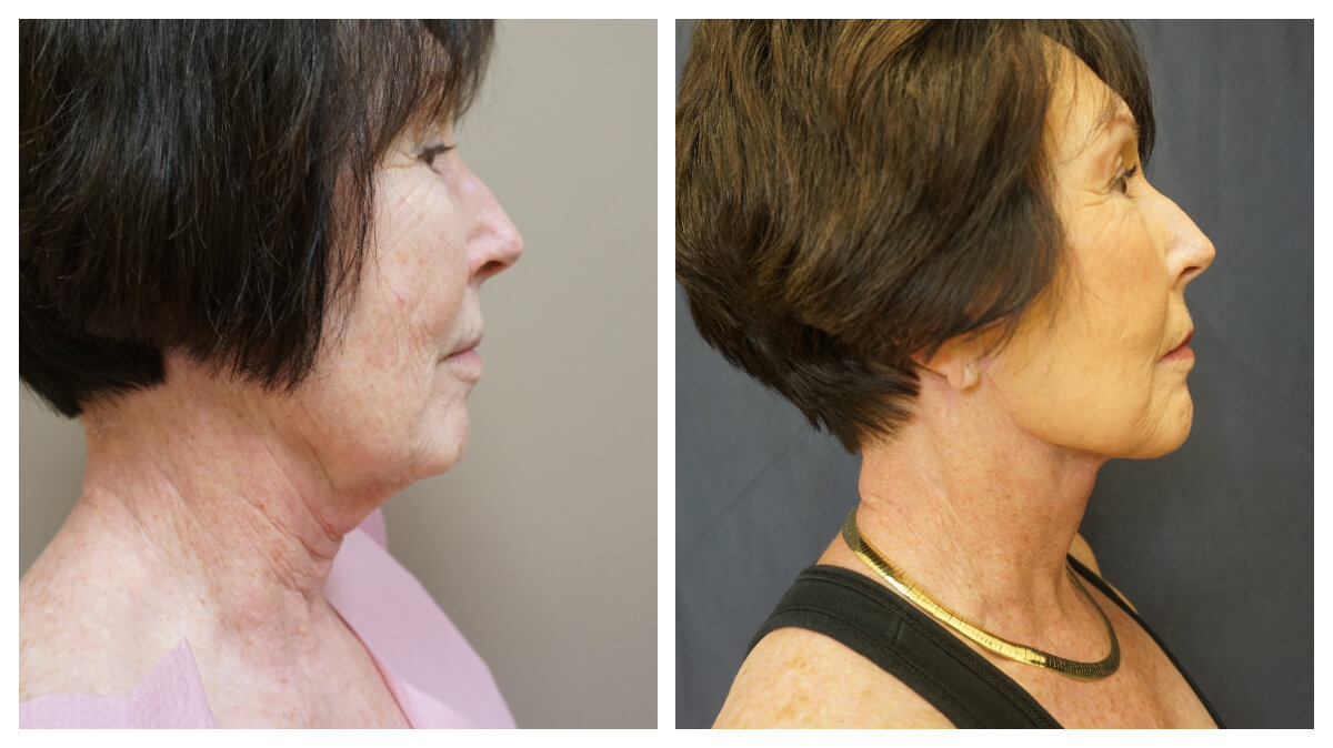 Example of Neck Lift. Akkary Surgery Center in Morgantown, WV