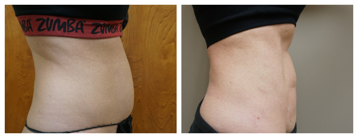 Example of Vaser Liposuction Morgantown, WV