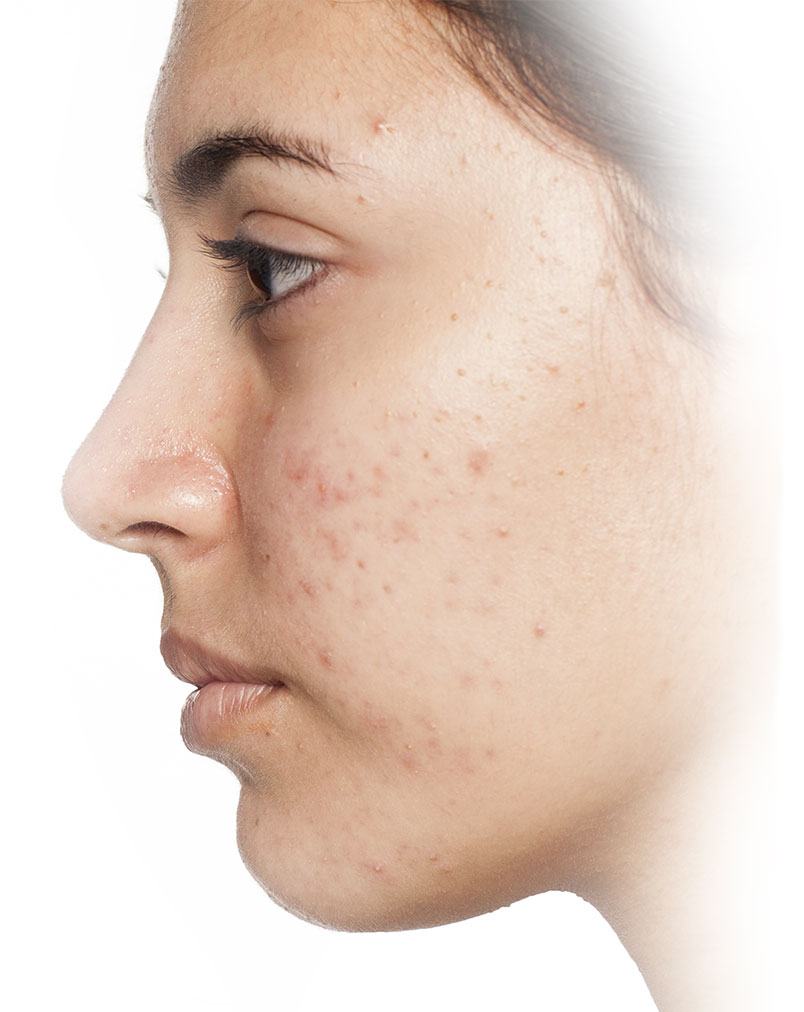 Acne Treatment, Skinsational Medspa, Morgantown, WV