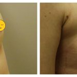 Breast augmentation with autologous fat transfer AFT