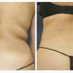 Back Liposuction