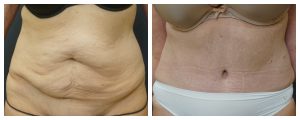Abdominoplasty