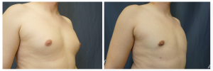 Gynecomastia excision