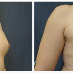 Chest liposuction with excision of gynecomastia