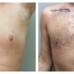 Chest liposuction with excision of gynecomastia