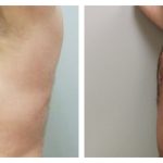 Chest liposuction with excision of gynecomastia
