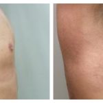 Chest liposuction with excision of gynecomastia