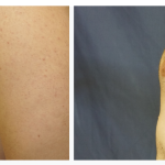 Chest liposuction with excision of gynecomastia