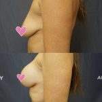 Breast Augmentation