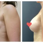 Breast Augmentation