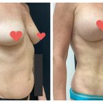 Breast Augmentation with Med def VASER liposuction ultrasound
