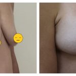 Breast Augmentation