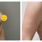 Breast Augmentation implants