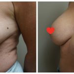 Breast Augmentation with lift (mastopexy)