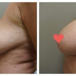 Breast Augmentation with lift (mastopexy)
