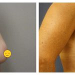 Breast Augmentation with lift (mastopexy)