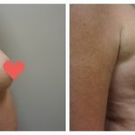 Breast Augmentation with lift (mastopexy)