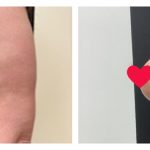 Breast Lift (Mastopexy)