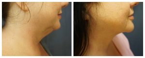 Submental liposuction with VASER and Renuvion