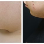 Submental liposuction