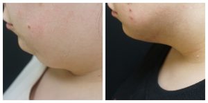 Submental liposuction