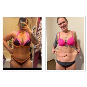 Abdominoplasty